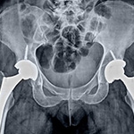 Total Hip Replacement in Royal Oak: What to Expect Before and After Surgery